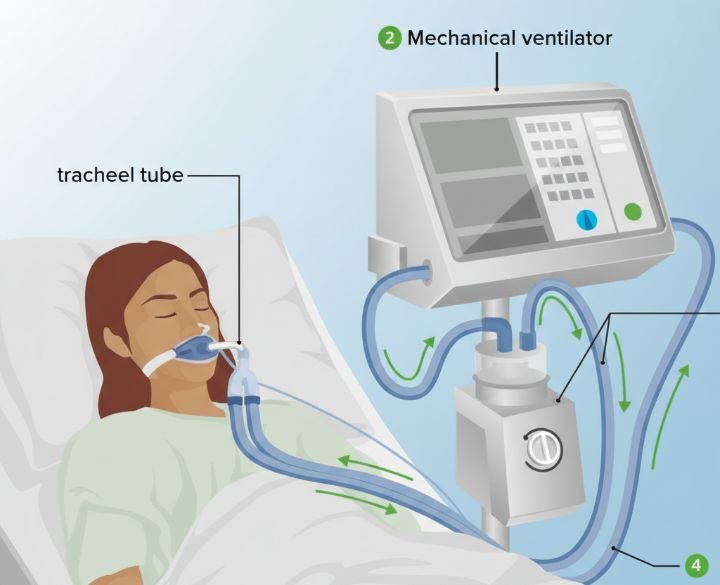 كورس جهاز التنفس الصناعي Mechanical Ventilation (كورس مكتوب)